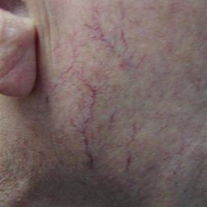 laser face treatment