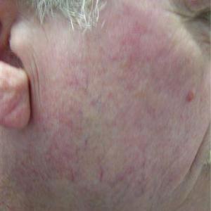 facial vein treatment