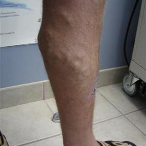 vein treatments pictures