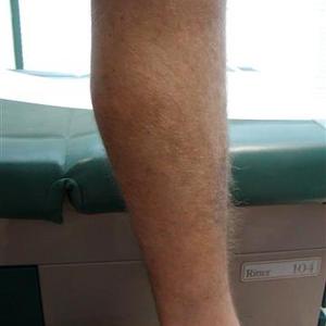 treatment for varicose vein