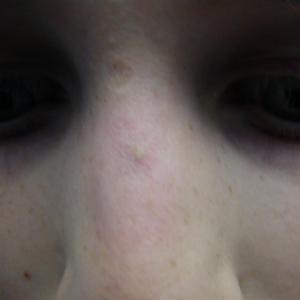 picture of nose vein treatment