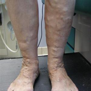 treating varicose vein