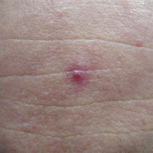 spider veins treatment