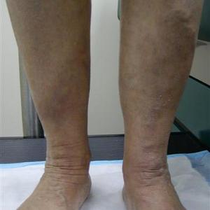 how to treat varicose vein