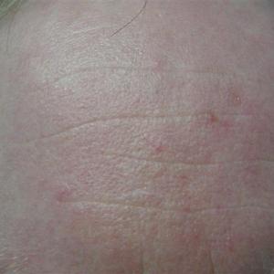 spider veins removal