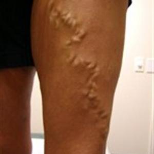 best varicose veins treatment