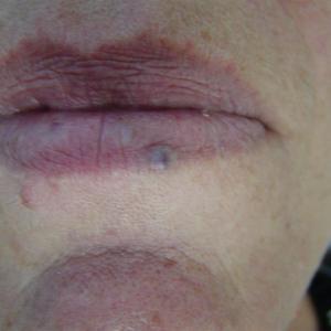 best facial vein treatments