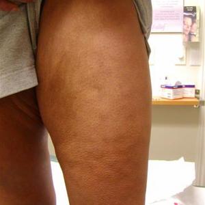 picture of leg vein treatment