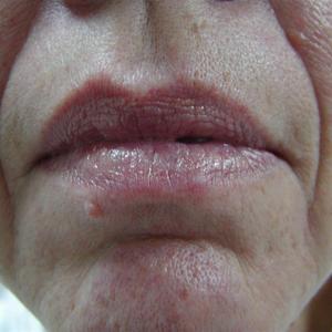 get rid of varicose veins