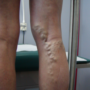 image of leg vein treatment