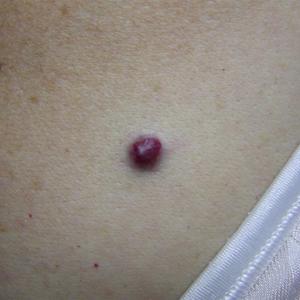 spider vein laser treatment
