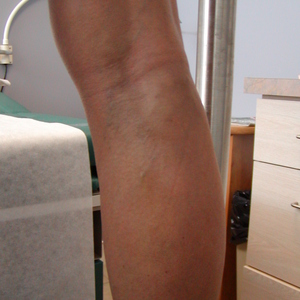 vein treatment for leg