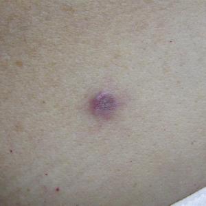 after spider vein laser treatment