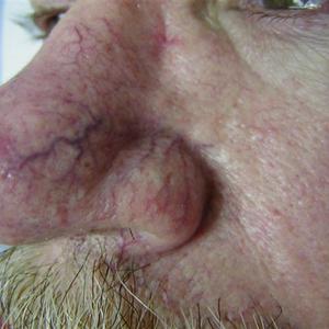 veins on nose treatment