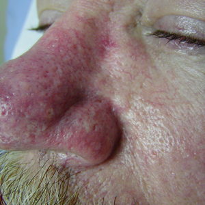 best nose vein treatment