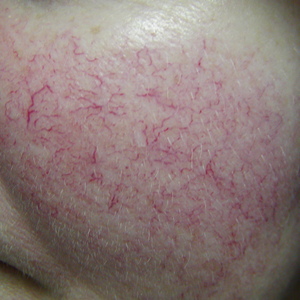 facial spider vein treatments