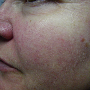 facial vein removal