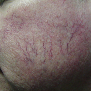 treatments for facial vein