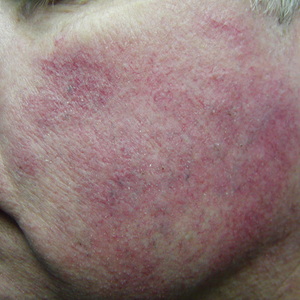 facial vein removal treatment