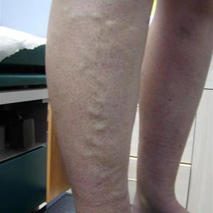 sclerotherapy treatment
