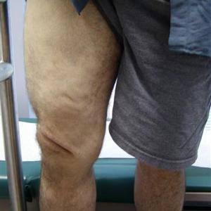 sclerotherapy treatment results