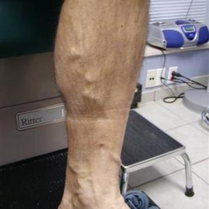varicose veins sclerotherapy