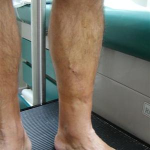 best sclerotherapy treatment