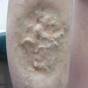 ultrasound guided sclerotherapy