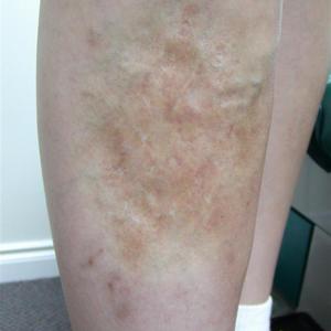 sclerotherapy treatment for vein in leg