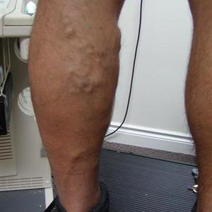 laser sclerotherapy treatment