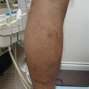 sclerotherapy aftercare